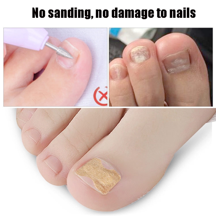 10 PCS Glue-free Orthopedic Nail Stick Toe Nail Groove Inlay Corrector(Blue  Bottom)